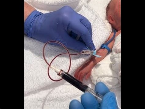 Venous Pool Technique Of Blood Sampling In Neonates