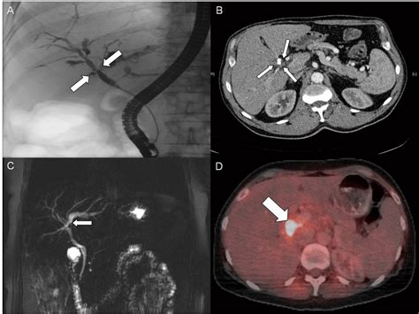 Klatskin Tumor Metastasis