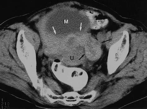 Ct And Mr Imaging Features Of Adnexal Torsion Radiographics