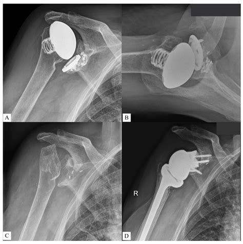 JCM Free Full Text Functional And Radiological Outcomes After