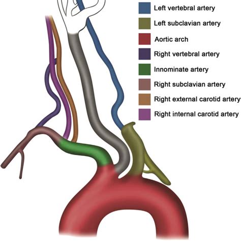 Angiography And Artist’s Interpretation Of Left Common Carotid Download Scientific Diagram