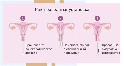Установка внутриматочной спирали - цены, установить ВМС в клинике ...