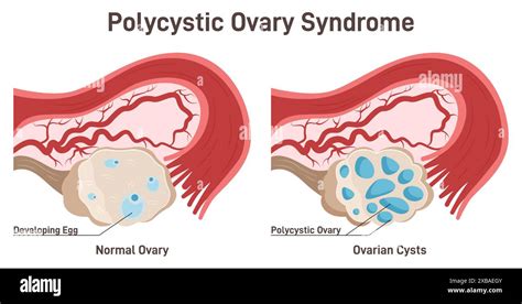 Polycystic Ovary Syndrome Pcos Hormonal Disease Female Reproductive