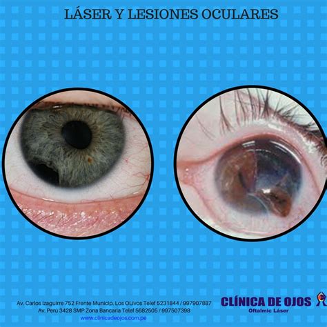 Cl Nica De Ojos Oftalmic L Ser L Ser Y Lesiones Oculares