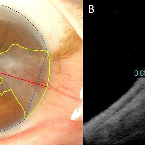 Anterior Segment Photography And Anterior Segment Optical Coherence Download Scientific Diagram