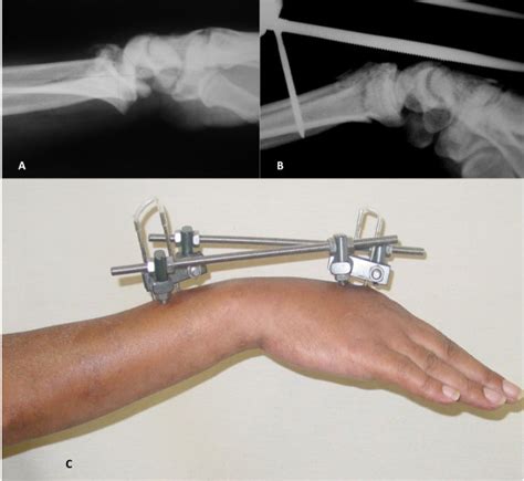 Bridging External Fixation Technique A Female 50 Years Old