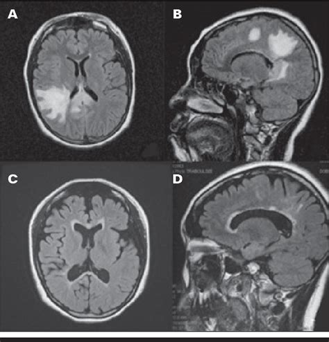 Figure 1 From Characterizing Pediatric Onset Neuromyelitis Optica Spectrum Disorder In British