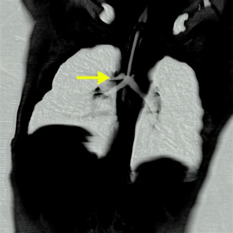 Elliot K Fishman Ctisus On Twitter Tracheal Stenosis And Pig