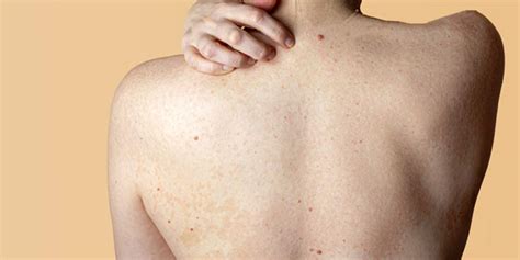 These Things Can Worsen Your Back Acne In Hindi इन पांच कारणों से पीठ