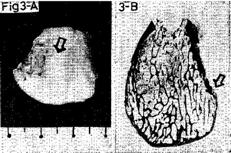 Figure 3 From Mandibular Condylar Hyperplasia Semantic Scholar