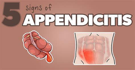 Rovsings Sign In Appendicitis Rovsings Sign For Appendicitis · Next