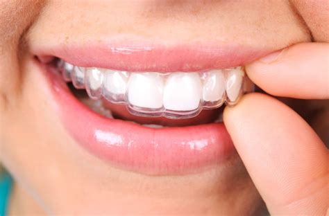 The Pros And Cons Of Invisalign Vs Braces 19th Ave Dental Care