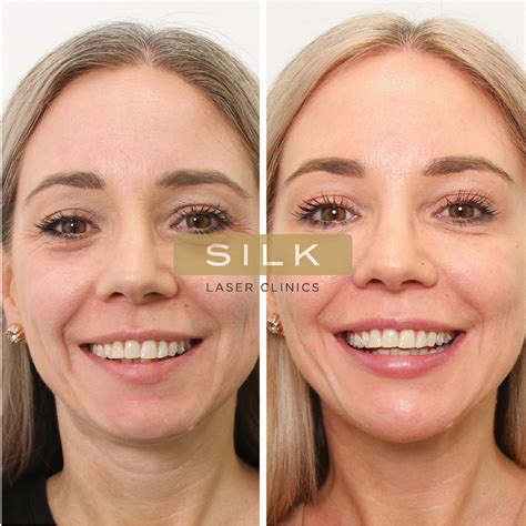 SILK Laser Clinics Skin Treatments Laser Clinics