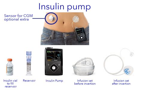 What Is Insulin Pump Therapy