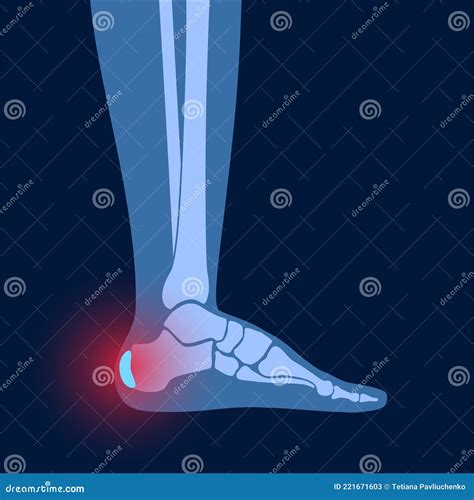 Bursitis Inflammation Concept Cartoon Vector Cartoondealer