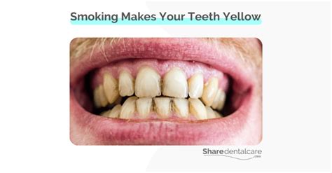 Does Smoking Make Your Teeth Yellow Share Dental Care