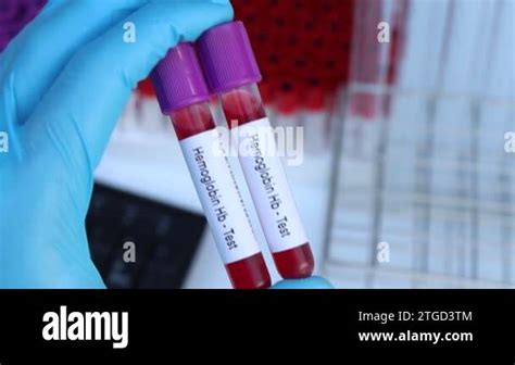 Hemoglobin Hb Test To Look For Abnormalities From Blood Blood Sample