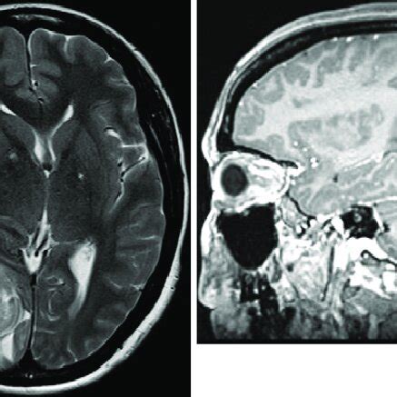 Preoperative Axial Precontrast T Weighted Left And Axial T Weighted