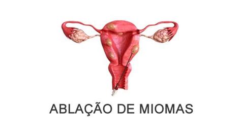 Ablação de mioma ablacaodemioma radiofrequência miomas ginecologia