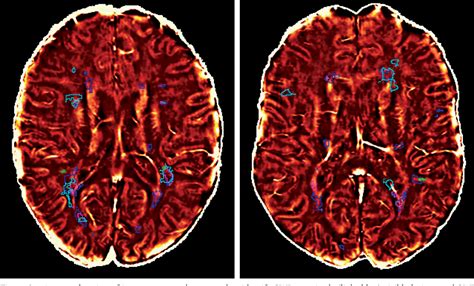 Figure 3 From Chronic Cerebrospinal Venous Insufficiency And Iron Deposition On Susceptibility