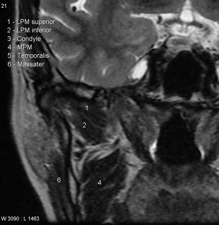 Lateral pterygoid muscle | Radiology Reference Article | Radiopaedia.org