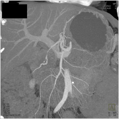 Pancreatic Cancer Encases The Pv Smv And Also Invades The Duodenum