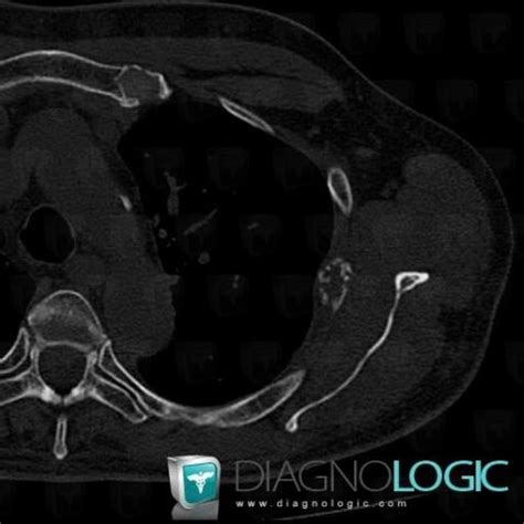 Cas Radiologie M Tastase Scanner Diagnologic