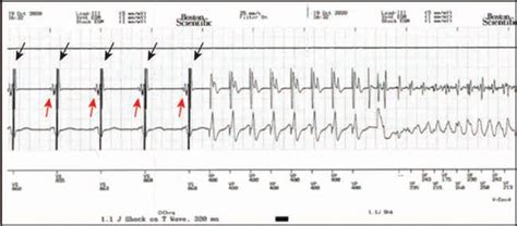 Native Signal Undersensing From Cardiac Contractility Modulation Ccm