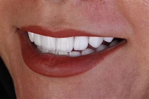 How Is The Price Of Composite Veneers Determined And What Are Its Most