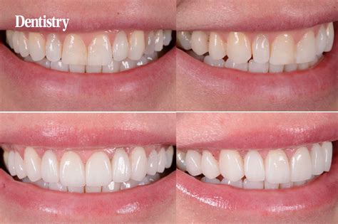 Predictability With Ceramic Veneers Dentistry