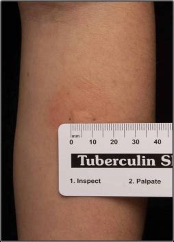 Tb Skin Test Mantoux Tuberculin Skin Test Tst