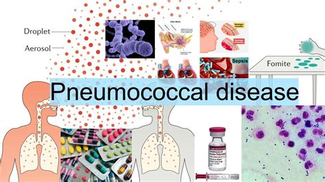 pneumococcal disease - YouTube