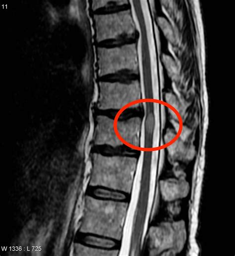 Transverse Myelitis Stepwards