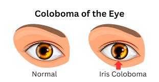 Coloboma: Insights into a Rare Eye Anomaly