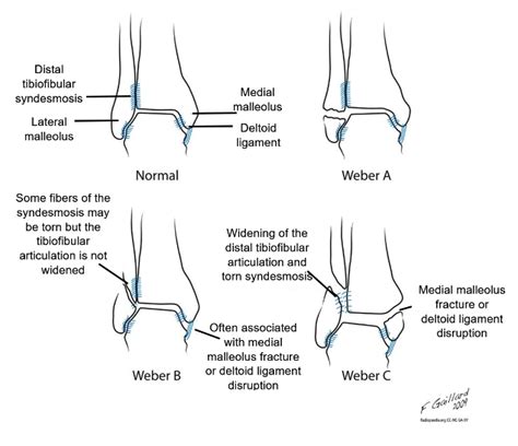 Case Report Trimalleolar Fracture Sports Medicine Review