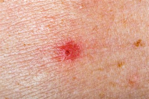 Inflamed red spot on skin stock photo. Image of allergy - 94578598