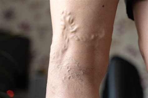 What Causes Varicose Veins Vascular Specialists Of Cfl