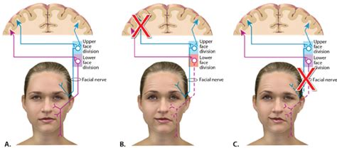 Bilateral Facial Nerve Palsy