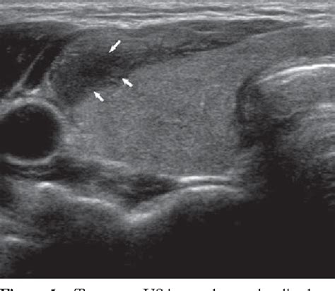 Figure 5 From Us Guided Fine Needle Aspiration Of Thyroid Nodules Indications Techniques