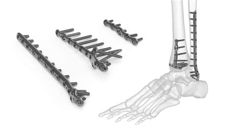 Acumed Ankle Plating System Medical Optical