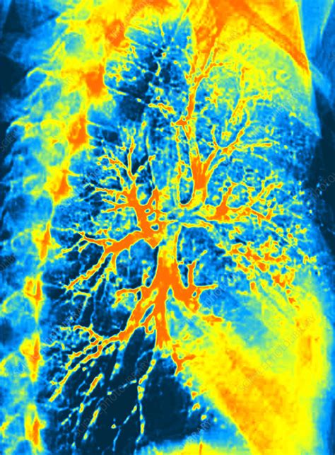 Lung Bronchogram Coloured X Ray Stock Image P590 0216 Science