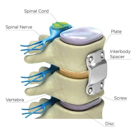 Anterior Cervical Decompression And Fusion At Drhc Dubai