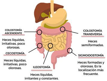 Alimentación y ostomías Nutreburgos