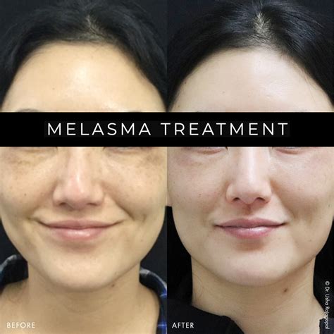 Hyperpigmentation Treatment Age Spots Sun Damage Pigmentation In