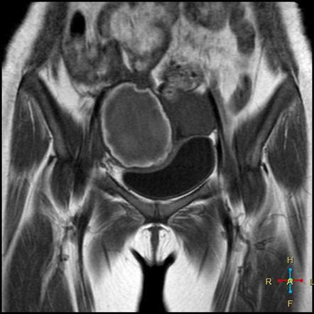 Hemorrhagic Ovarian Cyst Image Radiopaedia Org