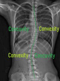 Scoliosis Exercises Posture Direct