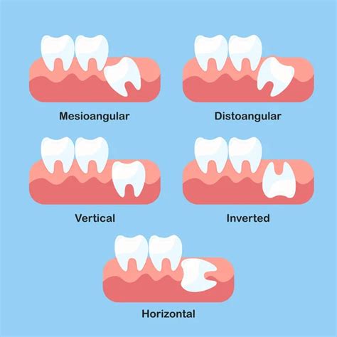 Horizontal Wisdom Tooth What Is It