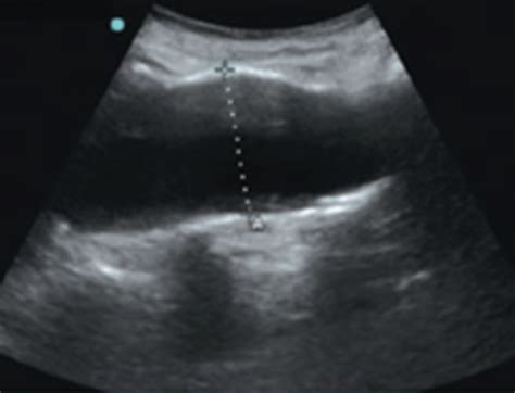 POCUS Made Easy AAA LITFL Ultrasound Library