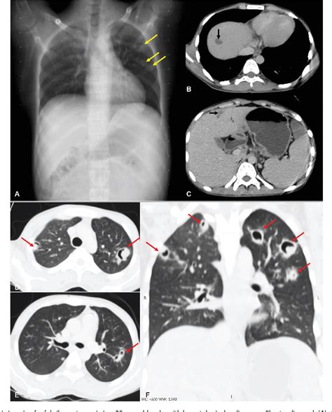 Figure 1 From Imaging Approach To Pulmonary Infections In The Immunocompromised Patient