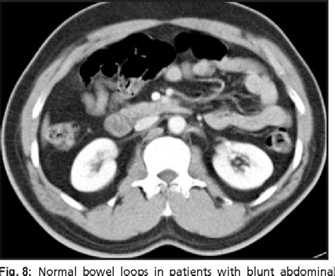 Figure 8 From Computed Tomography CT Of Bowel And Mesenteric Injury